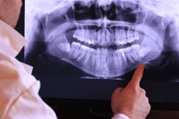 Best Emergency Tooth Extraction in Belmond, IA