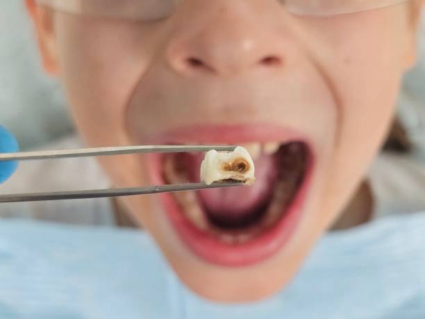 Best Emergency Wisdom Teeth Removal in Belmond, IA